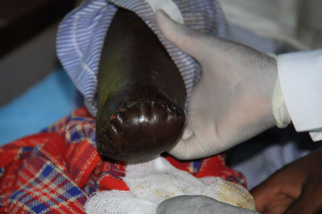 The lower leg of a Kenyan man bitten by a puff adder. 