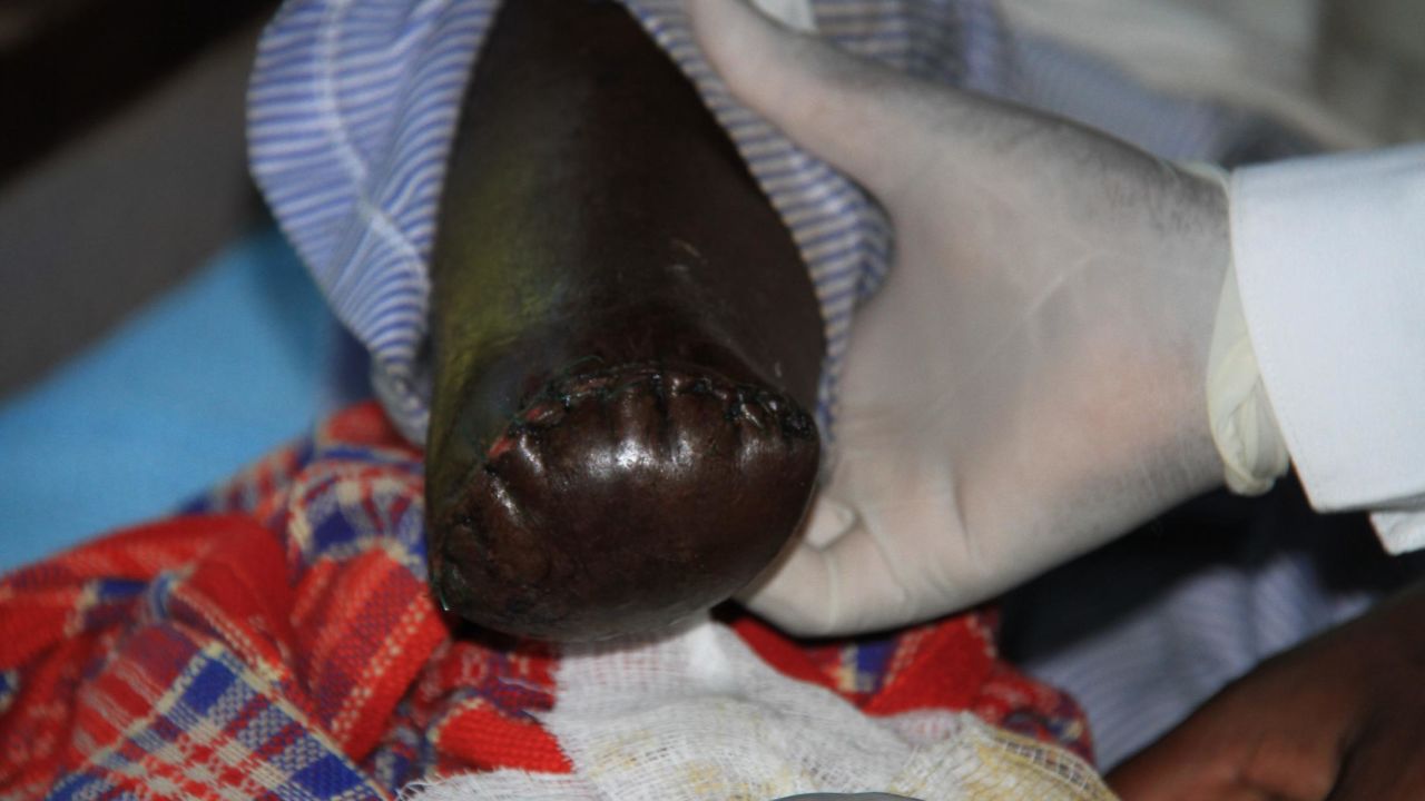 The lower leg of a Kenyan man bitten by a puff adder.