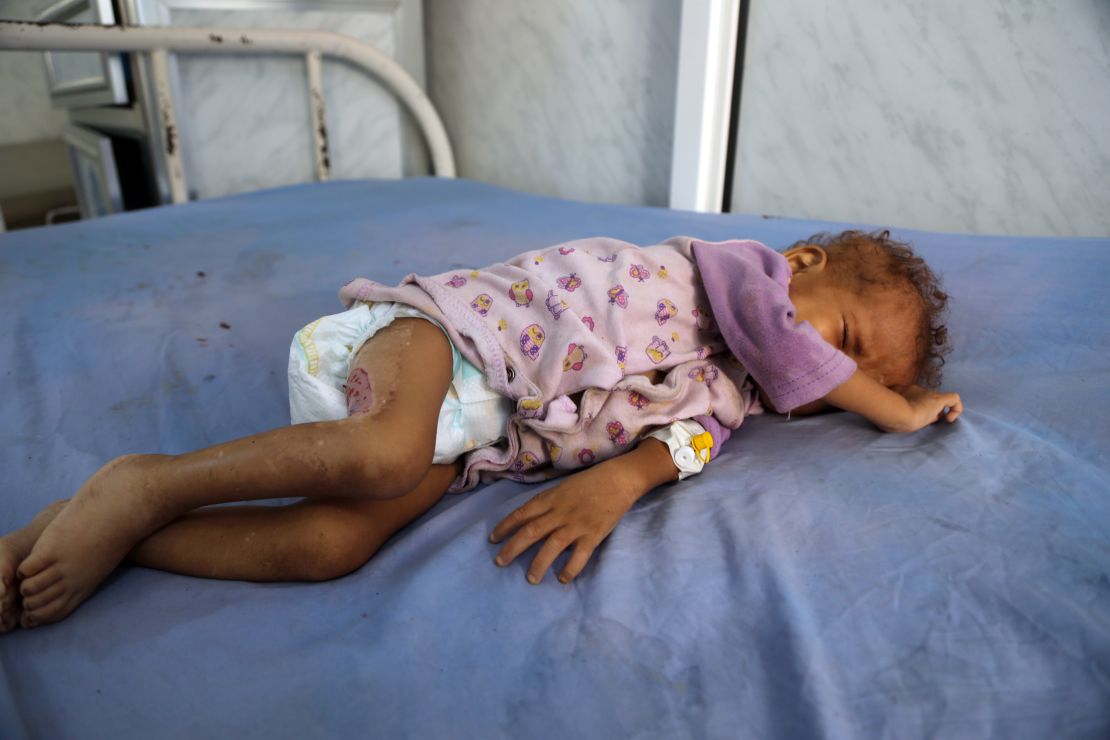 A malnourished Yemeni child receives treatment at a hospital in the Yemeni port city of Hodeidah in December.
The United Nations has listed Yemen as the world's No. 1 humanitarian crisis.