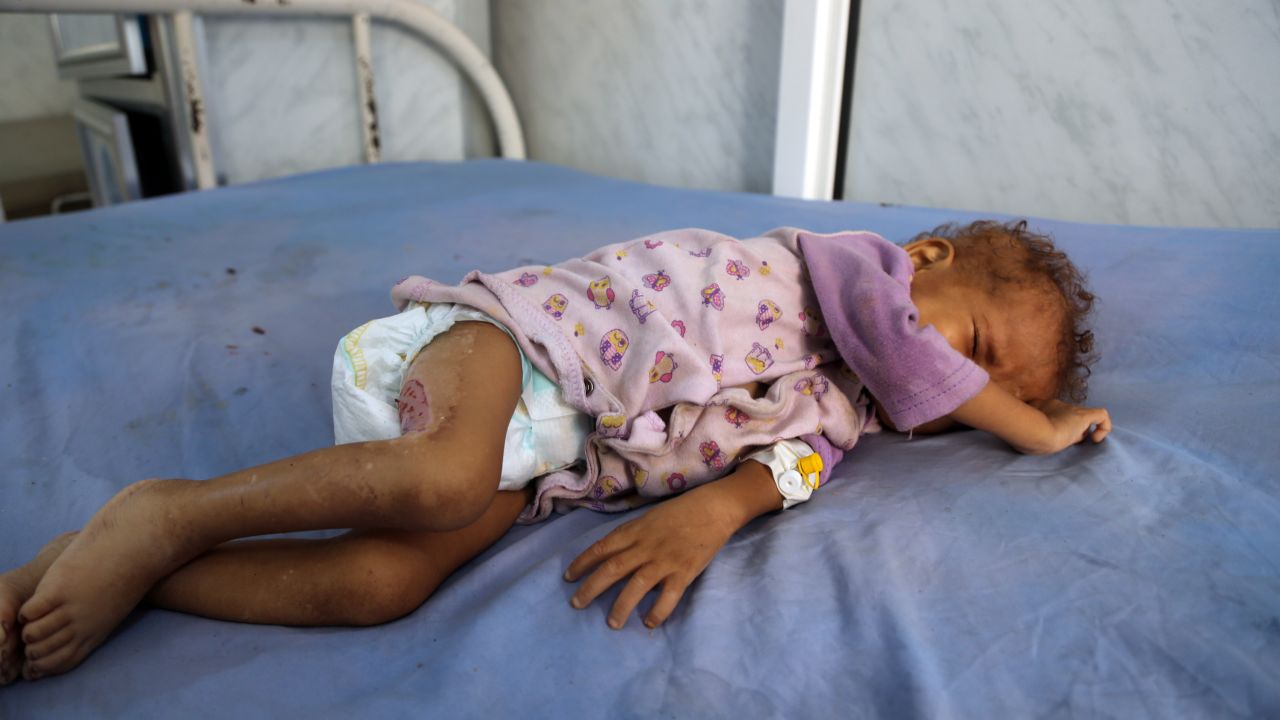 A malnourished Yemeni child receives treatment at a hospital in the Yemeni port city of Hodeidah in December.
The United Nations has listed Yemen as the world's No. 1 humanitarian crisis.