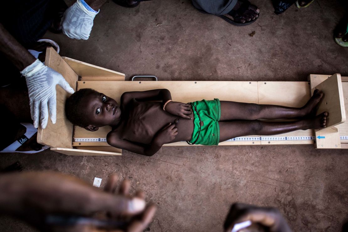 A child is measured at a clinic treating severe malnutrition on October 26, in Kasai, Democratic Republic of Congo. 