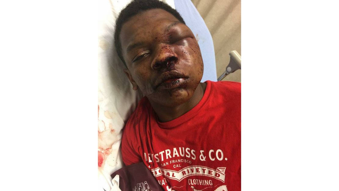 Ulysses Wilkerson, 17, was taken to the hospital after his arrest by Troy, Alabama, police. 