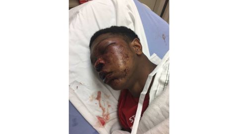 Ulysses' father says the boy was treated for brain swelling and a cracked eye socket.