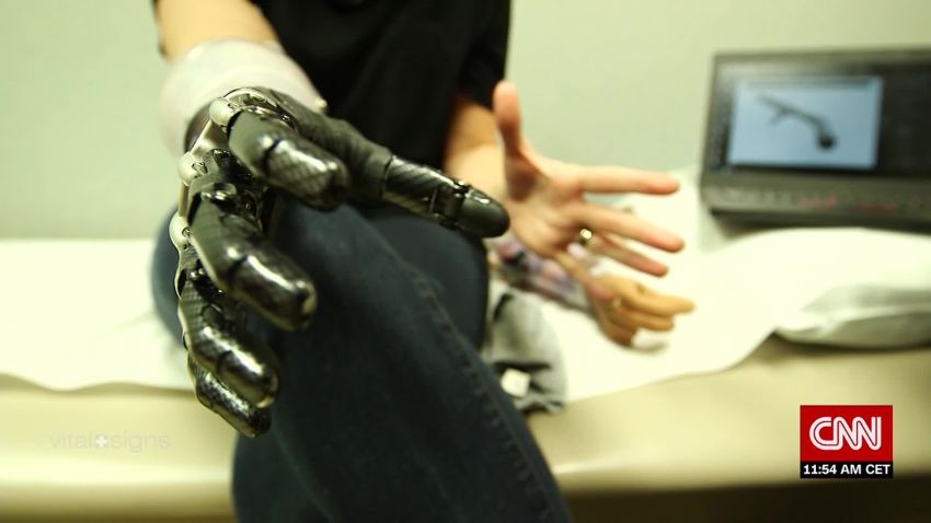 Vital Signs Mind-controlled prosthetics: the next wave of 'smart arms' C_00035327.jpg