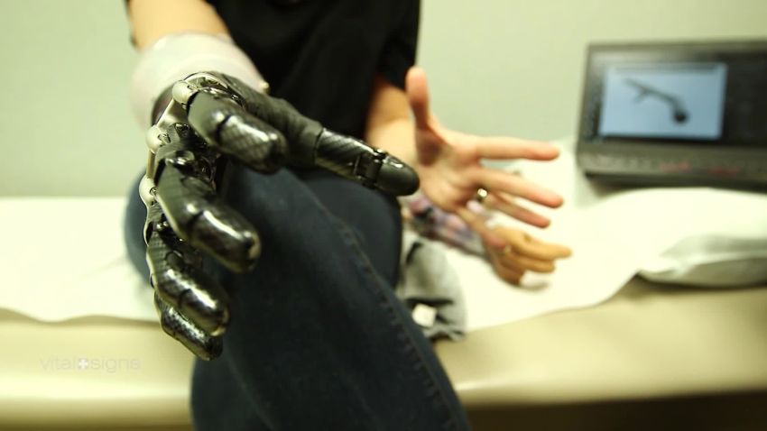 Vital Signs Mind-controlled prosthetics: the next wave of smart arms C_00042925.jpg