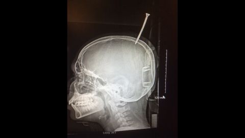 An x-ray shows the screw partially embedded between the two halves of Darius Foreman's brain.