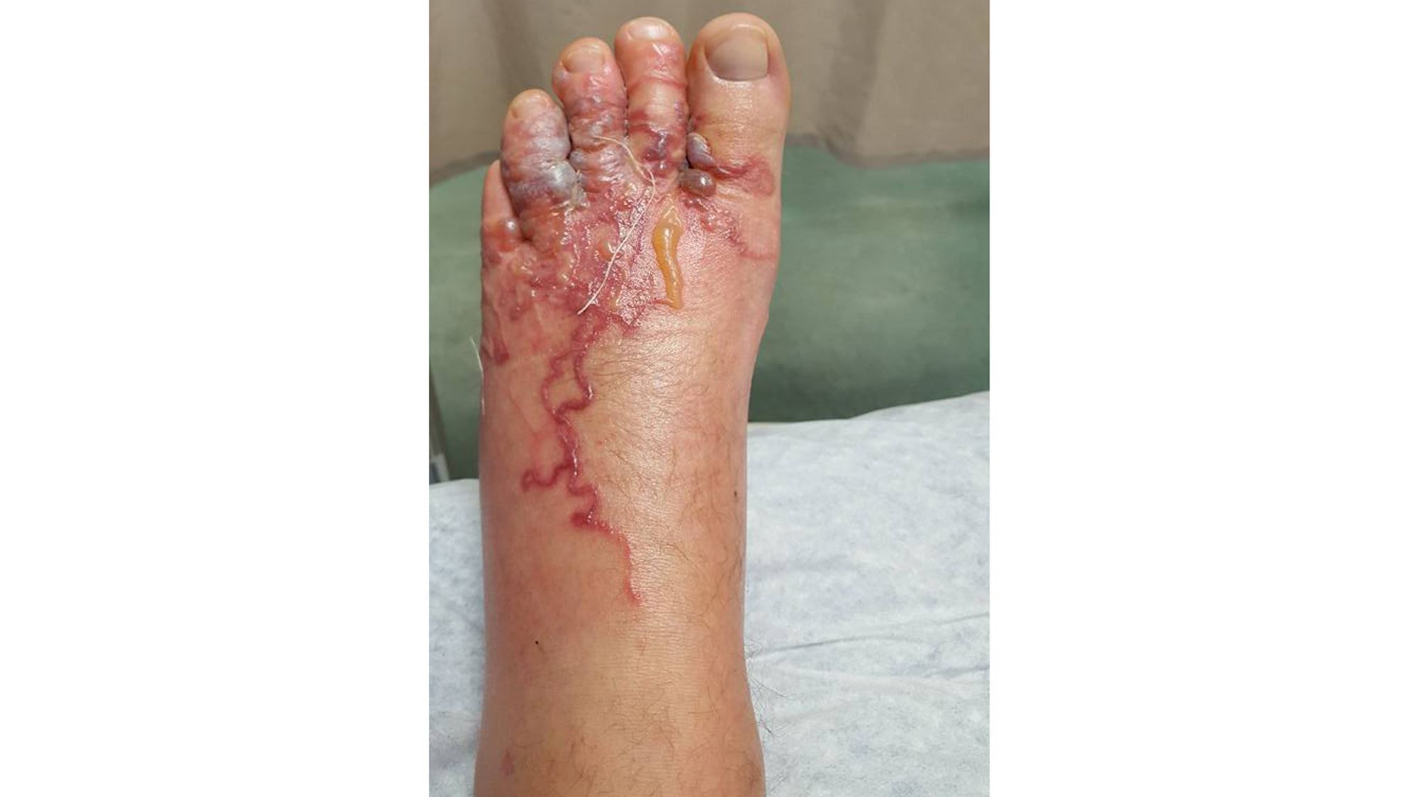 Couple finds worms in their feet after a beach vacation