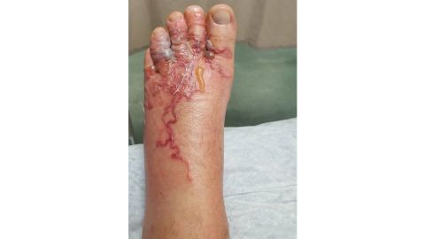 Cutaneous larva migrans occurs when hookworm larvae get into the skin.
