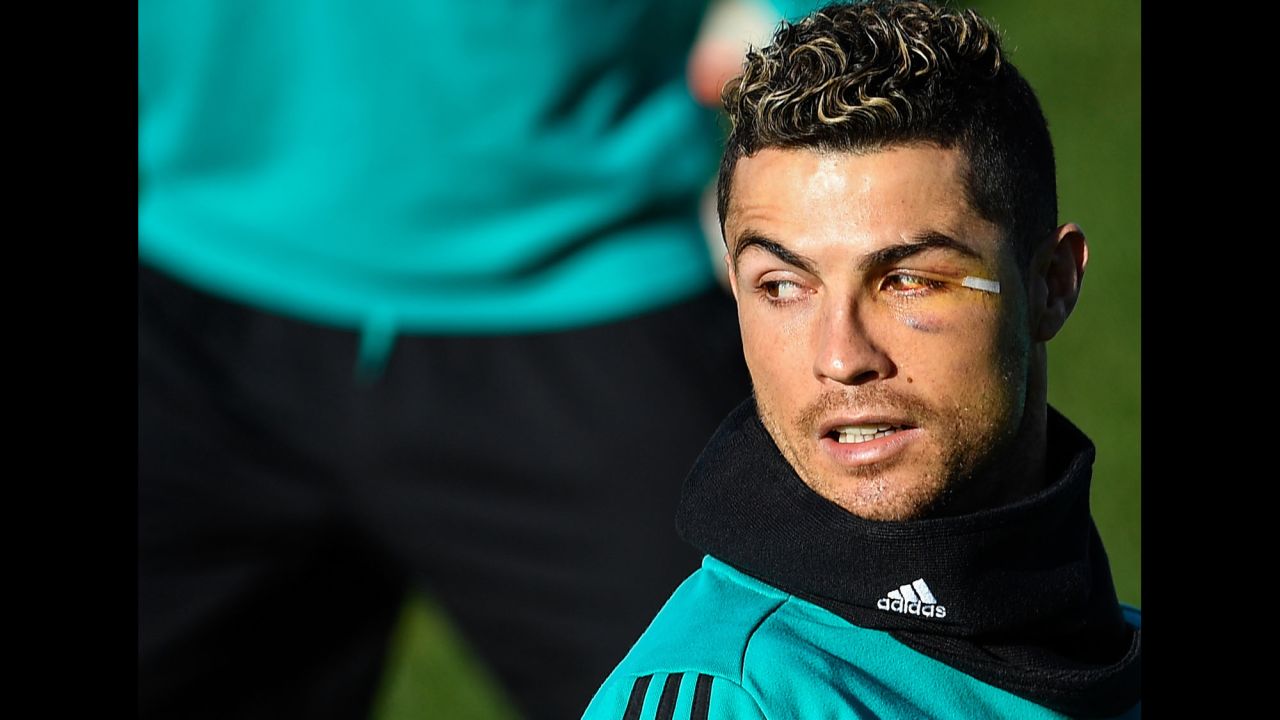 Cristiano Ronaldo's face is patched up during a training session in Madrid on Friday, January 26. The Real Madrid superstar got injured when he headed in a goal the weekend before.