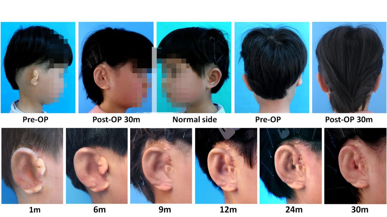 Editor's note: The photo accompanying this story has been blurred to protect a minor's identity.

In Vitro Regeneration of Patient-specific Ear-shaped Cartilage and Its First Clinical Application for Auricular Reconstruction
Zhou, Guangdong et al. EBioMedicine, published by Elsevier.
