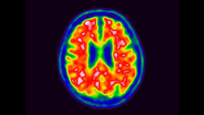 Alzheimers The Latest On Cancer Drugs Gene Therapy And The Apoe4 Gene - mzglp1e