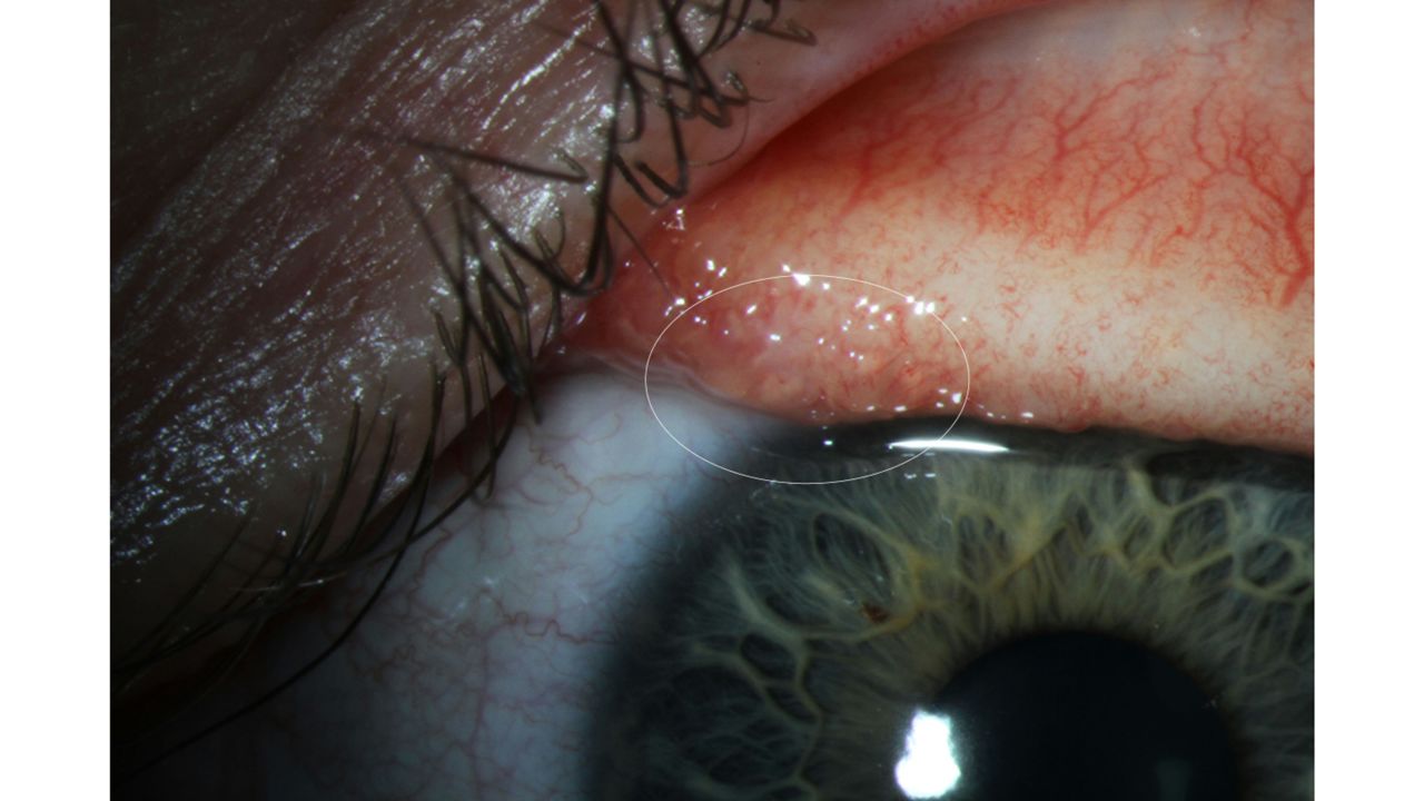 Abby Beckley's irritated eye with possible larvae.