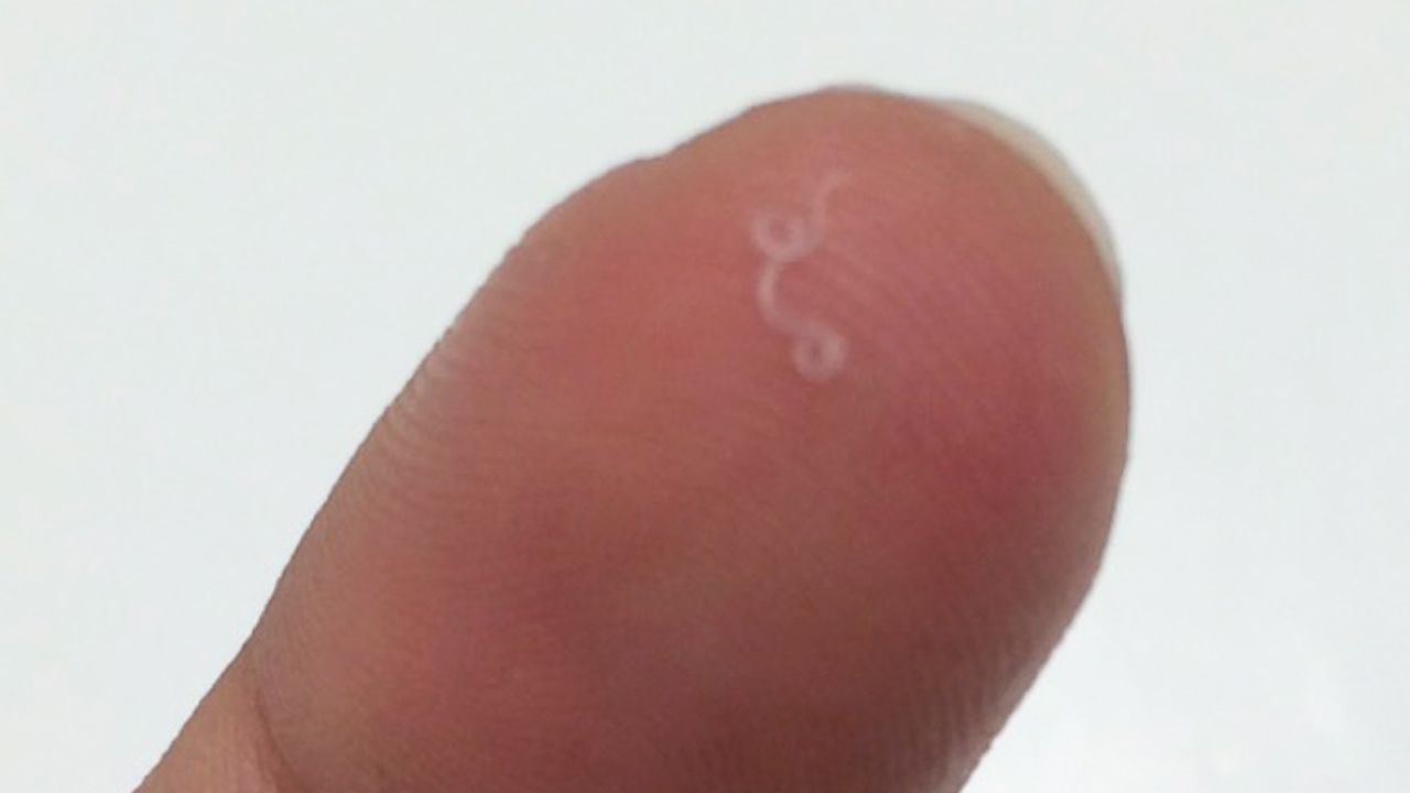 A worm pulled from Abby Beckley's eye.