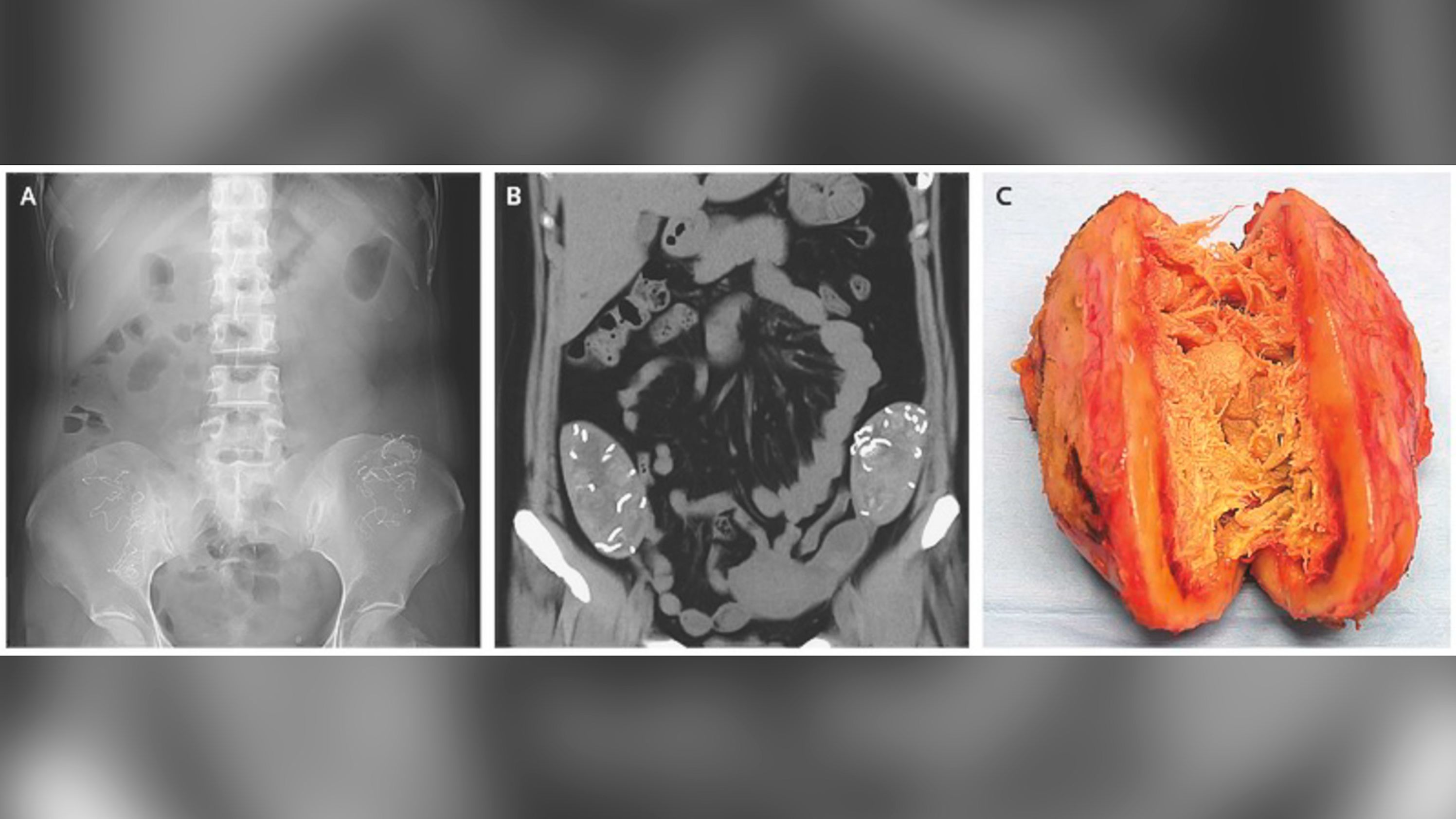 An X-ray, left, and CT scan, center, show two masses with stringy structures inside the patient's abdomen. Surgery revealed two sponges encapsulated by thick, fibrous tissue.