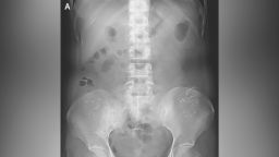 Abdominal radiographs showed hyperdense, serpiginous, symmetric lesions (Panel A). 