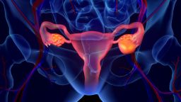 Illustration showing ovarian mass