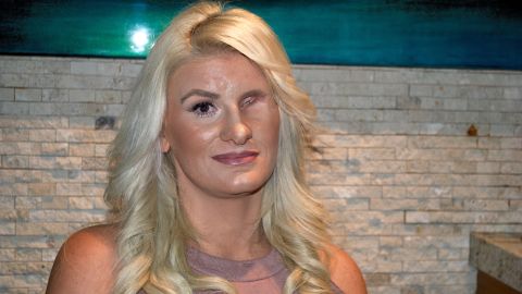 Chelsea Romo shows her face as she waits for a prosthetic eye. Generally, she brushes hair over her missing eye.