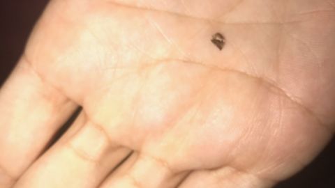 A piece of shrapnel that came to the surface of Chelsea Romo's nose.