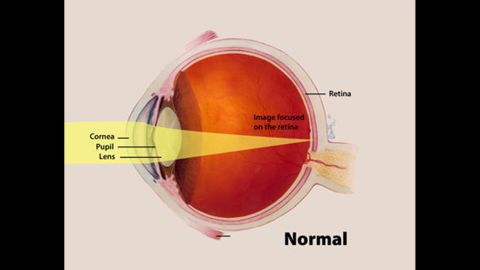 This illustration highlights the cornea, pupil and lens of a normal eye and how an image focuses on the retina.