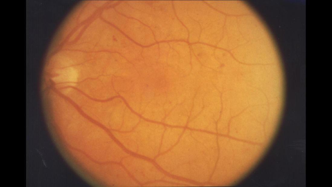 In background retinopathy, or damge to the retina, a slight deterioration in the small blood vessels occurs. Portions of the vessels may swell and leak fluid into the surrounding retinal tissue.