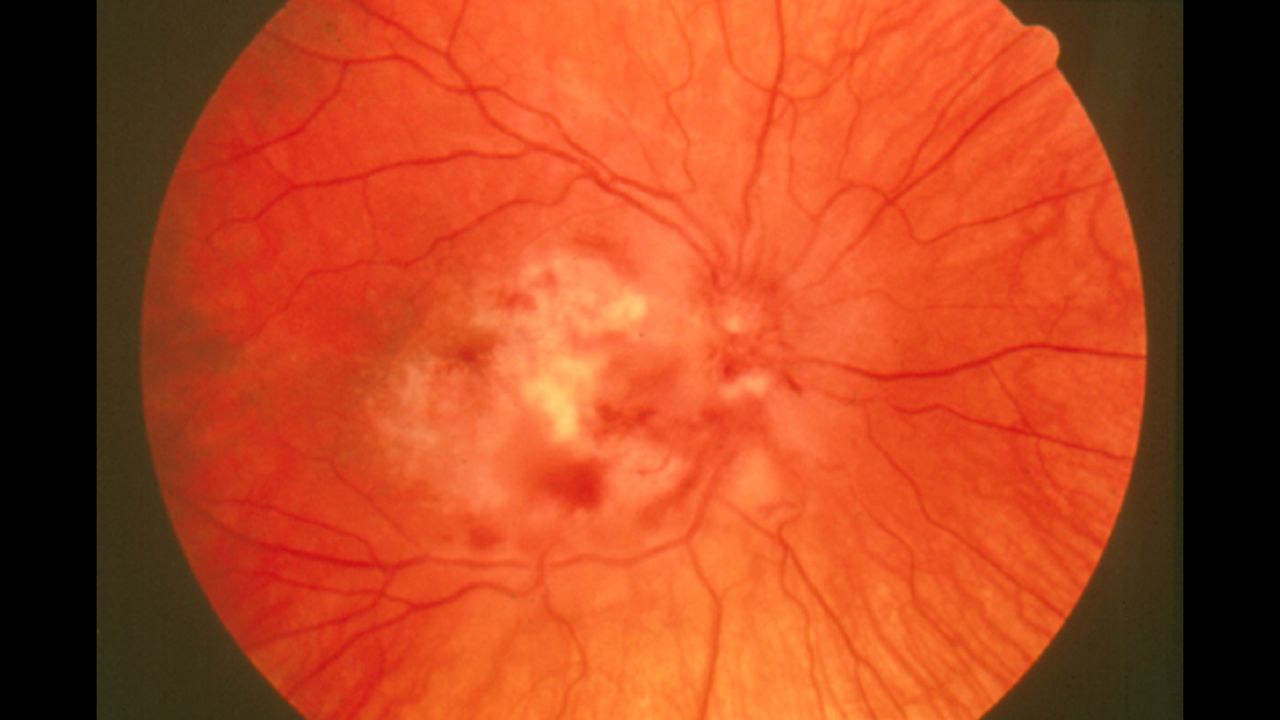 Cytomegalovirus (CMV) retinitis is caused by the herpes viruses that infects most adults. It is a serious eye infection, with symptoms that usually occur in people with weakened immune systems. Untreated, it can lead to vision problems.