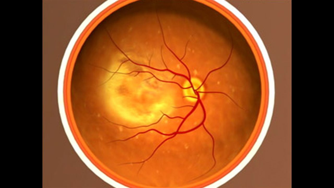 This photograph shows <a href="https://nei.nih.gov/health/maculardegen/armd_facts" target="_blank" target="_blank">age-related macular degeneration</a>, the leading cause of vision loss among people 50 and older, with fibrosis. It causes damage to the macula, a small spot near the center of the retina. The macula is the part of the eye needed for sharp, central vision.