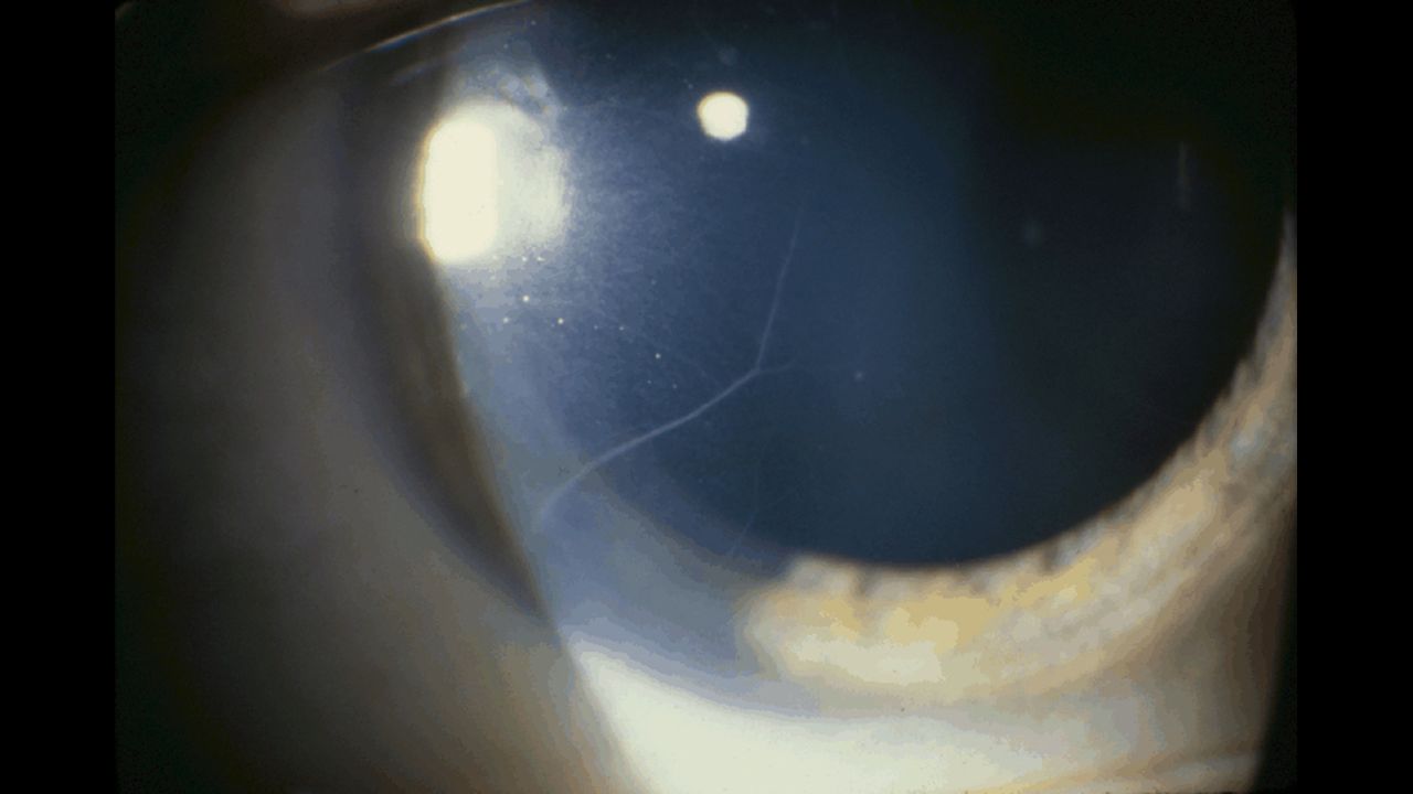 As seen in this photograph, <a href="https://www.thyroid.org/graves-eye-disease/" target="_blank" target="_blank">thyroid disease</a> may reveal prominent corneal nerves while causing dryness and bulging of the eye.