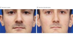 Two photos of a man illustrate the perceived differences in nose size at 12 inches versus 5 feet. 