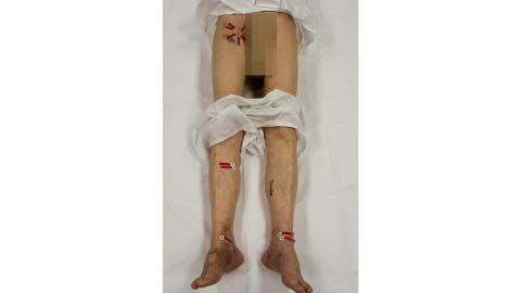 The doctor found 11 puncture wounds on Hamm's body.
