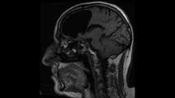 An MRI shows the air-filled cavity in the patient's brain.