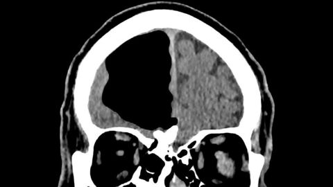 A CT scan of the man's head revealed a large air cavity compressing his right frontal lobe. The condition is known as pneumocephalus.