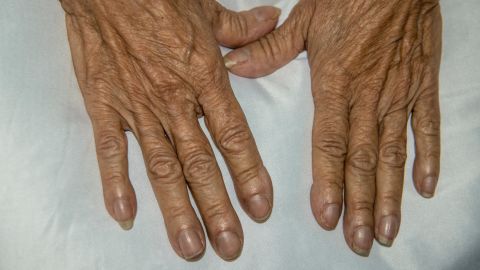 A phenomenon known as digital clubbing may also be a sign that all is not well with your heart. The fingernails change shape, becoming thicker and wider.