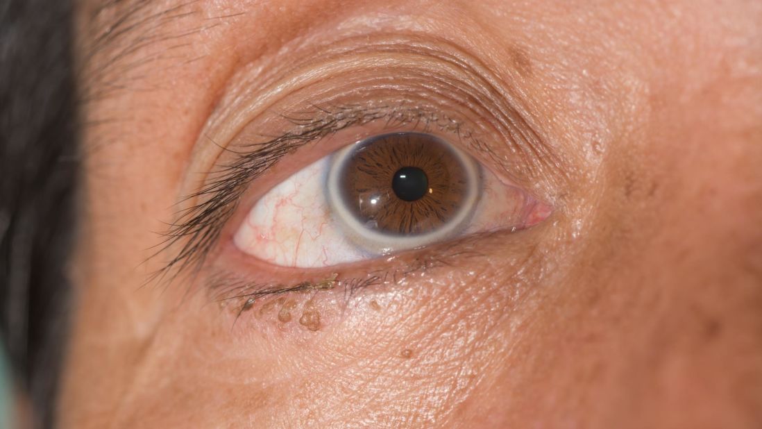 Fat deposits may also be seen as a gray ring around the outside of the iris, the colored part of the eye. 