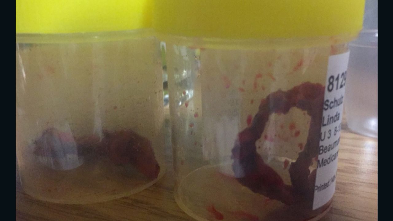The mesh that was removed from Linda Schulz after surgery.