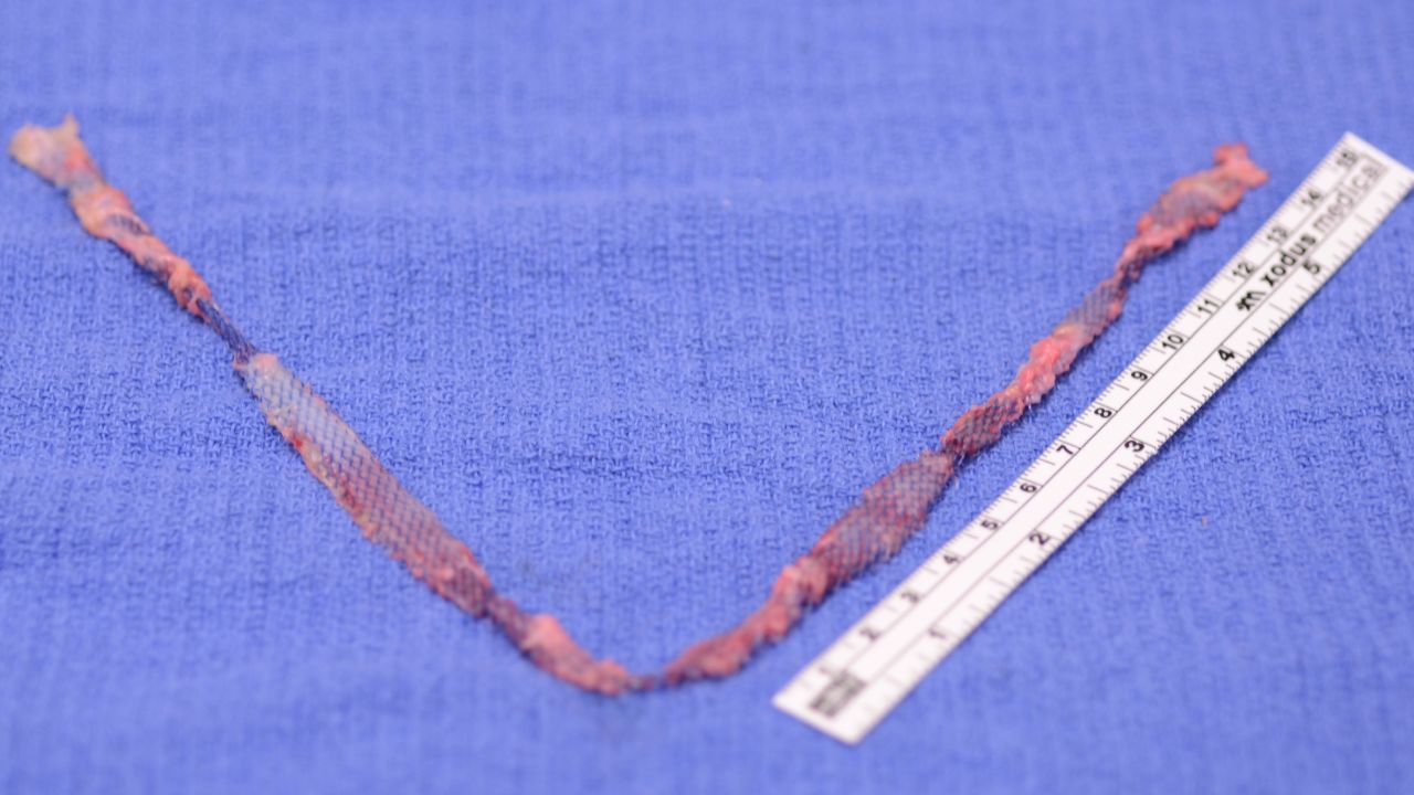 A pelvic mesh after removal.
