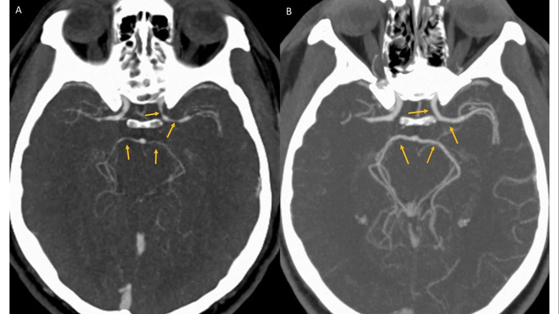 CT angiography shows the constriction of blood vessels in the brain shortly after the onset of symptoms, left, and upon resolution five weeks later. 