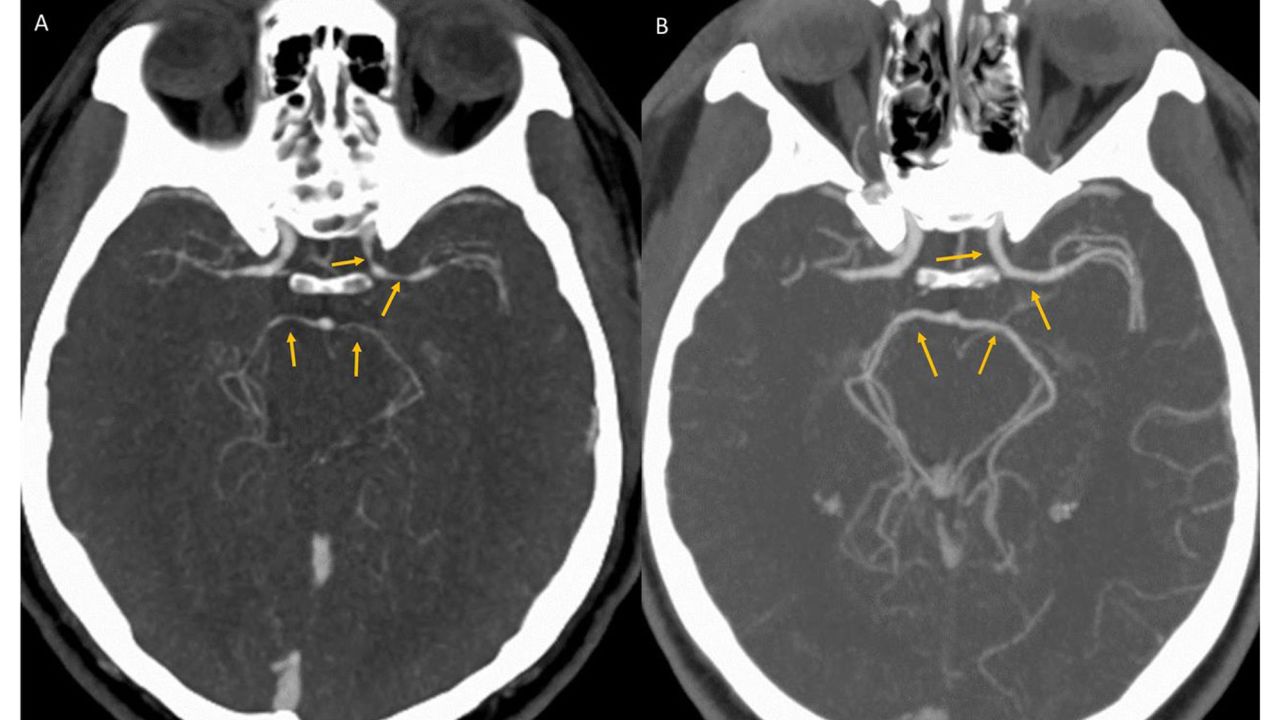 CT angiography shows the constriction of blood vessels in the brain shortly after the onset of symptoms, left, and upon resolution five weeks later. 