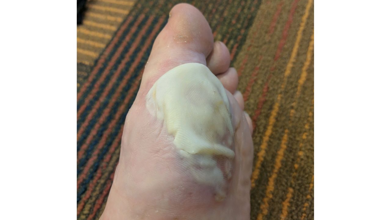 "I haven't seen my feet this bad since my days in the Army" two decades ago, teacher Craig Hoxie said.