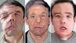Jérôme Hamon, 43, before his first face transplantation surgery (on left), after his first transplantation (middle), and then after his second transplantation (on right)