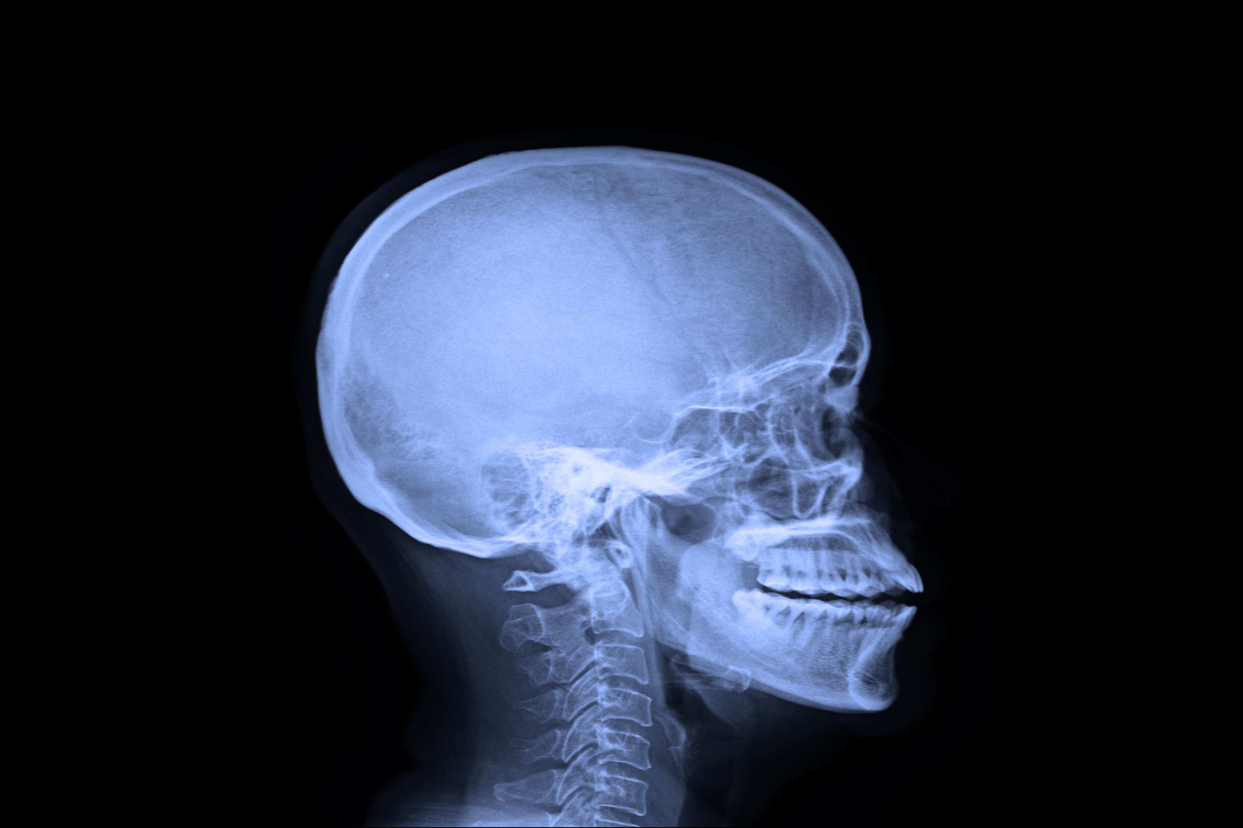 penetrating skull fracture