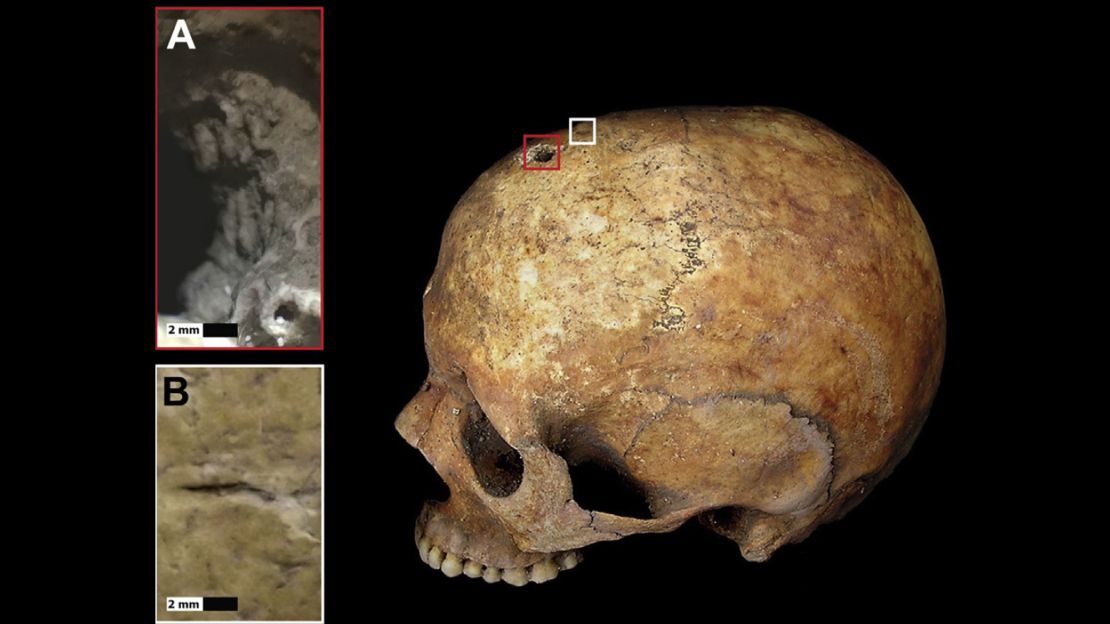 This image shows the 4.6-millimeter hole in the woman's skull.