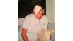 Allyson Allred after her eye was removed in 2001.