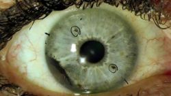 01 ocular melanoma