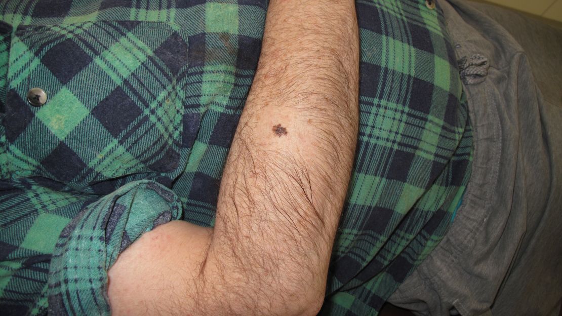 A melanoma skin cancer.