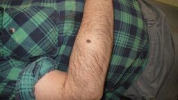 A melanoma skin cancer.