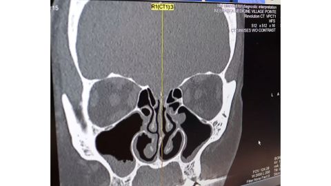 A CT scan of Jackson's sinuses shows a leak on the left side. 
