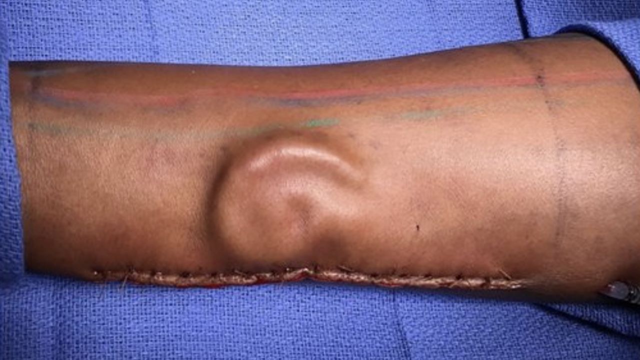 Yes, that's an ear, growing under the skin of an arm.
