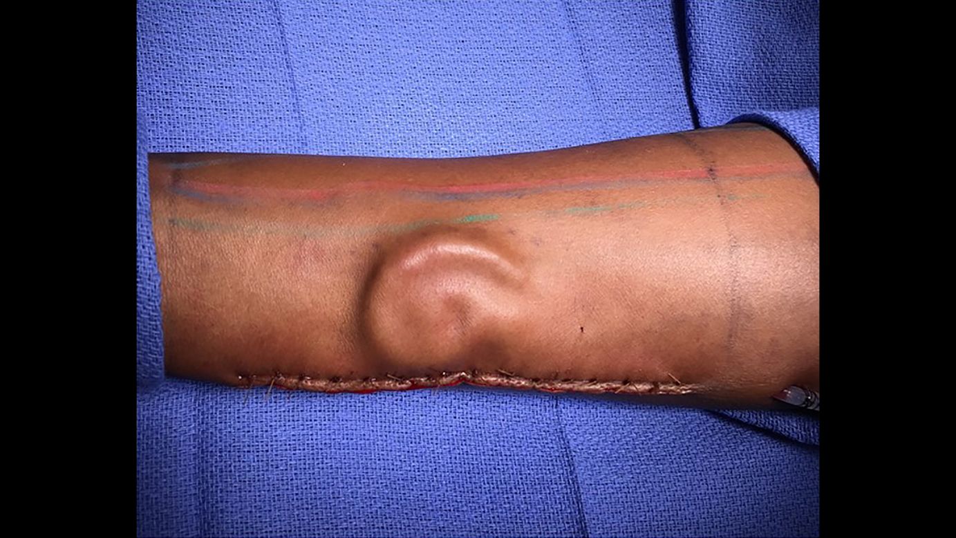 This photo, released on Monday, May 7, shows how doctors <a href="https://www.cnn.com/2018/05/10/health/ear-forearm-surgery-trnd/index.html" target="_blank">grew a US soldier's new ear in her forearm.</a> Pvt. Shamika Burrage lost her left ear in a car accident two years ago, but plastic surgeons were able to harvest cartilage from her ribs to create a new one. It grew in her arm and then was successfully attached to her head.