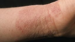 Contact Dermatitis. (Photo By BSIP/UIG Via Getty Images)