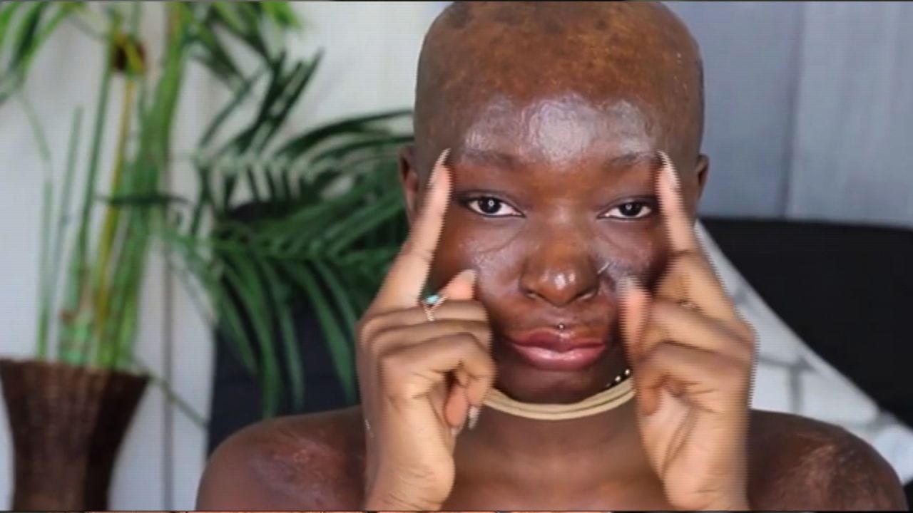 Shalom Blac was burned in a kitchen accident when she was 9 years old.